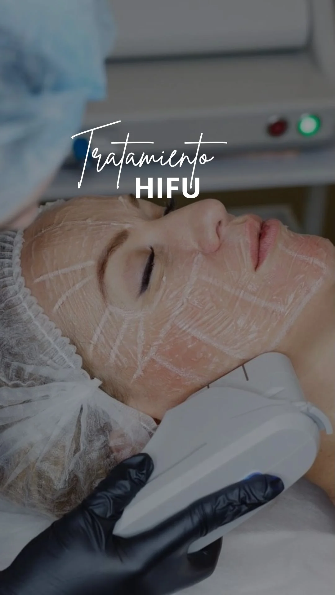 ¿HIFU o Radiofrecuencia? Cuál elegir